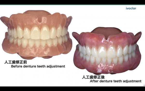 義歯（入れ歯）とはバレたくない方必見！IDTの確かな技術を一部紹介！